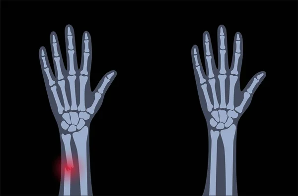 Fratura conceito de raio x — Vetor de Stock