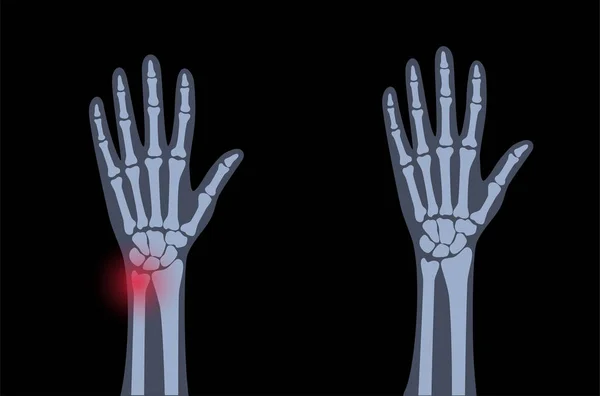 Fratura conceito de raio x —  Vetores de Stock