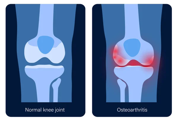 Artritida v kolenním kloubu — Stockový vektor