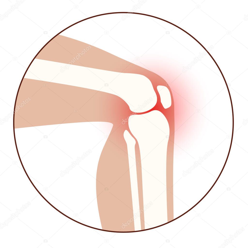 Arthritis knee joint icon. Rheumatoid arthritis clinic logo. Pain in leg. Human bone anatomy flat vector illustration. Skeleton x ray scan concept. Painful injury erosion on medical poster for clinic.
