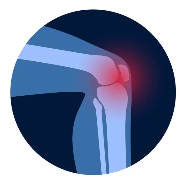 Arthritis in knee joint — Stock Vector