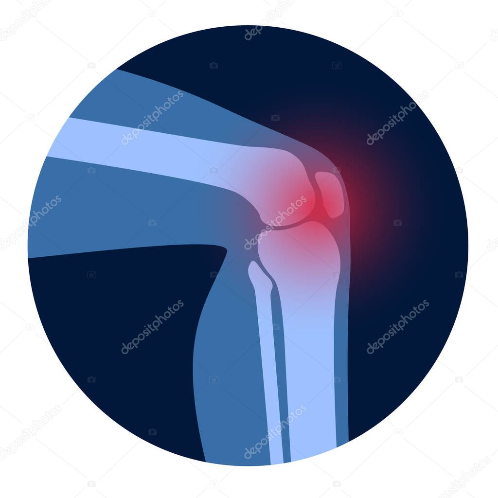 Arthritis knee joint icon. Rheumatoid arthritis clinic logo. Pain in leg. Human bone anatomy flat vector illustration. Skeleton x ray scan concept. Painful injury erosion on medical poster for clinic.