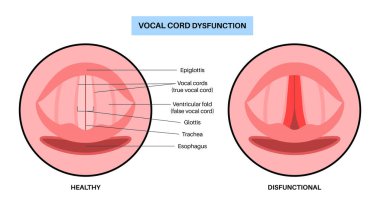 Ses telleri işlevsiz tıbbi poster. Klinik solunum yolu bozukluğu, ses kıvrımları ilham veya son kullanma sırasında anormal bir şekilde kapanır. Nefes darlığı, çabalama, öksürük ve ses düz vektör değiştirir.