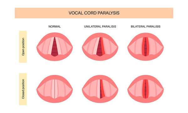 Vocal cords paralysis, laryngeal disorder caused by nerve dysfunction. Impairing voice, breathing, and swallowing. Laryngoscopy concept. Rehabilitation for airway and speech restoration medical vector