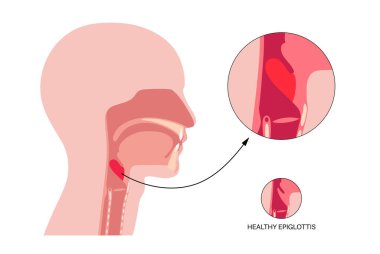 Epiglottitis tıbbi poster. Haemophilus influenzae gibi bakteriyel enfeksiyonlardan kaynaklanan epiglotun akut iltihabı. Şişkinlik, hava yolu tıkanıklığı, stridor, disspnea ve ateş vektörü.