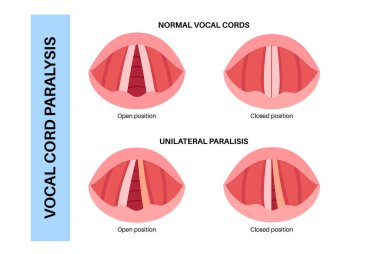 Ses telleri felci, sinir bozukluğundan kaynaklanan gırtlak rahatsızlığı. Sesi, nefesi ve yutkunmasını engelliyor. Laringoskopi konsepti. Solunum yolu ve konuşma yenileme tıbbi vektörü için rehabilitasyon