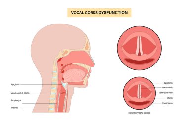 Ses telleri işlevsiz tıbbi poster. Klinik solunum yolu bozukluğu, ses kıvrımları ilham veya son kullanma sırasında anormal bir şekilde kapanır. Nefes darlığı, çabalama, öksürük ve ses düz vektör değiştirir.