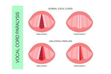 Ses telleri felci, sinir bozukluğundan kaynaklanan gırtlak rahatsızlığı. Sesi, nefesi ve yutkunmasını engelliyor. Laringoskopi konsepti. Solunum yolu ve konuşma yenileme tıbbi vektörü için rehabilitasyon