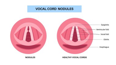 Ses kablosu nodülleri. İyi huylu, çift taraflı nasır. Fonda oluşan lezyonlar gibi. Aşırı kullanım, gerginlik, bağırış, şarkı söyleme. Hoaress, dysphonia, vokal yorgunluk gibi semptomlar. Laringoskopi veya stroboskopi vektörü