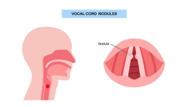 Ses kablosu nodülleri. İyi huylu, çift taraflı nasır. Fonda oluşan lezyonlar gibi. Aşırı kullanım, gerginlik, bağırış, şarkı söyleme. Hoaress, dysphonia, vokal yorgunluk gibi semptomlar. Laringoskopi veya stroboskopi vektörü