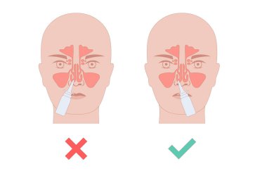 Doğru burun spreyi kullanımı. Burnu temizliyor, başı dik tutuyor, hortumu bir burun deliğine sokuyor ve sprey sıkarken nazikçe nefes alıyor. Doğru teknik etkili tedavi vektörü sağlar