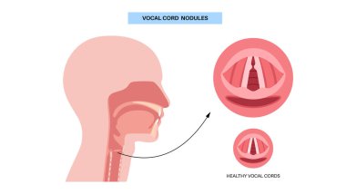 Ses kablosu nodülleri. İyi huylu, çift taraflı nasır. Fonda oluşan lezyonlar gibi. Aşırı kullanım, gerginlik, bağırış, şarkı söyleme. Hoaress, dysphonia, vokal yorgunluk gibi semptomlar. Laringoskopi veya stroboskopi vektörü