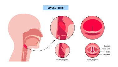 Epiglottitis tıbbi poster. Haemophilus influenzae gibi bakteriyel enfeksiyonlardan kaynaklanan epiglotun akut iltihabı. Şişkinlik, hava yolu tıkanıklığı, stridor, disspnea ve ateş vektörü.