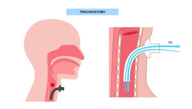 Trakeostomi tıbbi posteri. Cerrahi prosedür, soluk borusundaki solunum yolu stomalı tüp, manşet, flanj ve kravatlar. Üst solunum yolunun havalandırma baypası, salgıların emilmesi düz vektör.