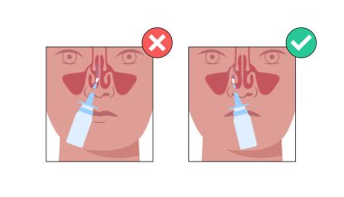 Doğru burun spreyi kullanımı. Burnu temizliyor, başı dik tutuyor, hortumu bir burun deliğine sokuyor ve sprey sıkarken nazikçe nefes alıyor. Doğru teknik etkili tedavi vektörü sağlar