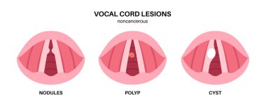 Ses teli lezyonları tıbbi poster. Nodüller, polipler ve kistler. Beyinsizliğe, disfoniye ve hava yolu sorunlarına neden oluyorlar. Teşhis, laringoskopi ve biyopsiye dayanır. Gırtlak anatomisi düz vektör çizimi