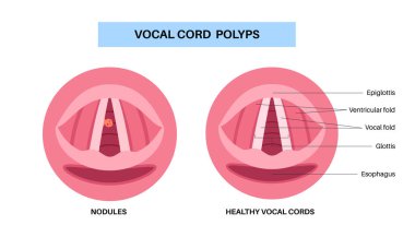 Ses kablosu polip tıbbi poster. Gırtlakta iyi huylu lezyon. Hoaress, dysphonia ve ses değişikliği. Laringoskopi ya da endoskopi prosedürü. Ses gerginliği, tahriş veya sigara içilen düz vektör çizimi