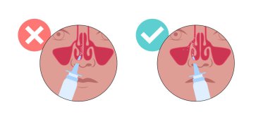 Doğru burun spreyi kullanımı. Burnu temizliyor, başı dik tutuyor, hortumu bir burun deliğine sokuyor ve sprey sıkarken nazikçe nefes alıyor. Doğru teknik etkili tedavi vektörü sağlar