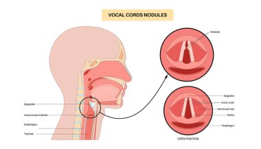 Ses kablosu nodülleri. İyi huylu, çift taraflı nasır. Fonda oluşan lezyonlar gibi. Aşırı kullanım, gerginlik, bağırış, şarkı söyleme. Hoaress, dysphonia, vokal yorgunluk gibi semptomlar. Laringoskopi veya stroboskopi vektörü