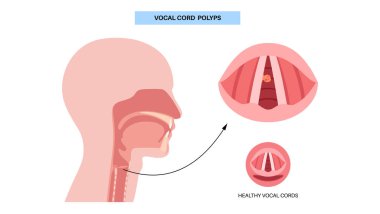Ses kablosu polip tıbbi poster. Gırtlakta iyi huylu lezyon. Hoaress, dysphonia ve ses değişikliği. Laringoskopi ya da endoskopi prosedürü. Ses gerginliği, tahriş veya sigara içilen düz vektör çizimi