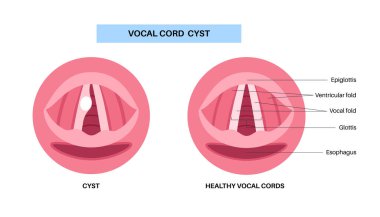 Ses kablosu kisti. İyi huylu gırtlak lezyonu sesin katlanmasını etkiler. Hoaress, dysphonia, ve titreşim bozukluğu. Laringoskopi, endoskopi ya da biyopsi yoluyla teşhis konulabilir. Ses terapisi vektör illüstrasyonu
