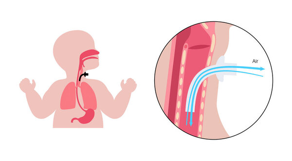 Tracheostomy medical poster. Surgical procedure, airway in the trachea with stoma, cannulated tube, cuff, flange, and ties. Ventilation bypass of the upper airway, suction of secretions flat vector