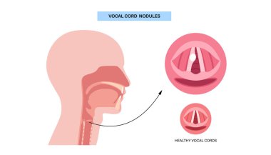 Ses kablosu kisti. İyi huylu gırtlak lezyonu sesin katlanmasını etkiler. Hoaress, dysphonia, ve titreşim bozukluğu. Laringoskopi, endoskopi ya da biyopsi yoluyla teşhis konulabilir. Ses terapisi vektör illüstrasyonu