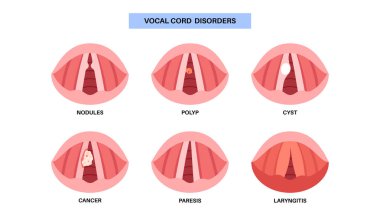 Ses teli lezyonları tıbbi poster. Nodüller, polipler ve kistler. Beyinsizliğe, disfoniye ve hava yolu sorunlarına neden oluyorlar. Teşhis, laringoskopi ve biyopsiye dayanır. Gırtlak anatomisi düz vektör çizimi