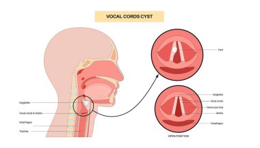Ses kablosu kisti. İyi huylu gırtlak lezyonu sesin katlanmasını etkiler. Hoaress, dysphonia, ve titreşim bozukluğu. Laringoskopi, endoskopi ya da biyopsi yoluyla teşhis konulabilir. Ses terapisi vektör illüstrasyonu