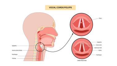 Ses kablosu polip tıbbi poster. Gırtlakta iyi huylu lezyon. Hoaress, dysphonia ve ses değişikliği. Laringoskopi ya da endoskopi prosedürü. Ses gerginliği, tahriş veya sigara içilen düz vektör çizimi