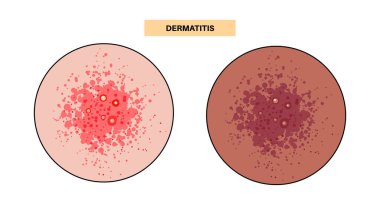 Dermatit posteri. Deri reaksiyonu, alerji veya tahriş edici kızarıklık, kaşıntı, şişkinlik ve kabarcıklar. Kronik deri hasarı vektörünü önlemek için hızlı tanımlama ve koruyucu tedbirler gereklidir