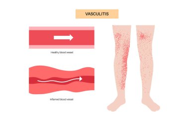 Vasculitis medical poster. Autoimmune disease, inflammation of blood vessels, swelling, tissue damage, and potential organ dysfunction. Diagnosis and appropriate treatment flat vector illustration