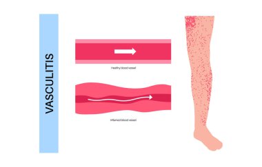 Vasculitis medical poster. Autoimmune disease, inflammation of blood vessels, swelling, tissue damage, and potential organ dysfunction. Diagnosis and appropriate treatment flat vector illustration