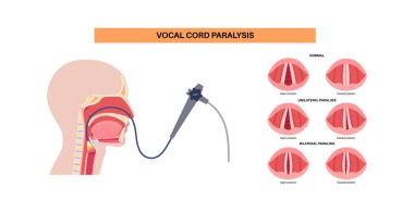 Ses telleri felci, sinir bozukluğundan kaynaklanan gırtlak rahatsızlığı. Sesi, nefesi ve yutkunmasını engelliyor. Laringoskopi konsepti. Solunum yolu ve konuşma yenileme tıbbi vektörü için rehabilitasyon
