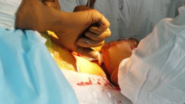 Bir odada kesilmiş bir hastanın bacağında uzun tıbbi aletler tutan doktorlardan oluşan ekip metalik aletler uygulayan bir kişinin bacağında ortopedik cerrahi uygulayan beyaz üniformalı birkaç cerrahın çarpıcı görünümü