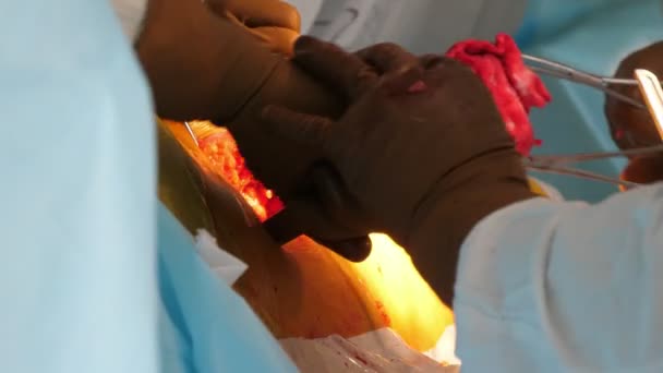 도구를 적용하는 사람의 무릎에 수술을 유니폼에 의사의 흥미로운 보기에서 환자의 — 비디오