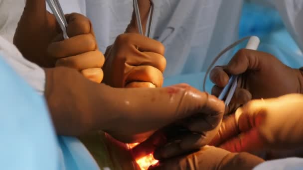 Muitos Médicos Segurando Instrumentos Médicos Longos Perna Paciente Cortado Uma — Vídeo de Stock