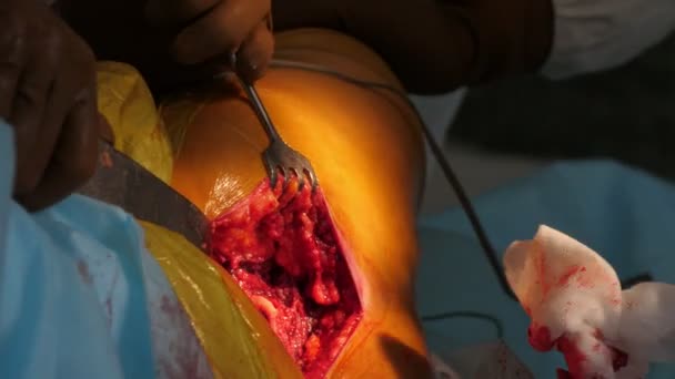 Cirurgia Ortopédica Impressionante Uma Espécie Endoprótese Ucrânia Tempo Real Visão — Vídeo de Stock