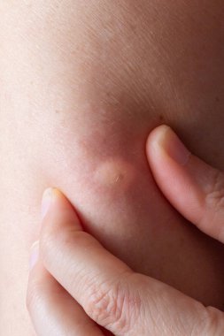 Close-up of woman's fingers touching an inflamed pustule on skin, highlighting skin problems and dermatological issues