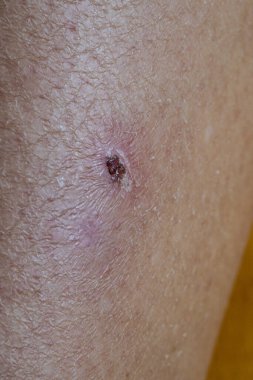 Close-up of an infected wound healing on dry skin, showing damaged tissue and the body's natural recovery process