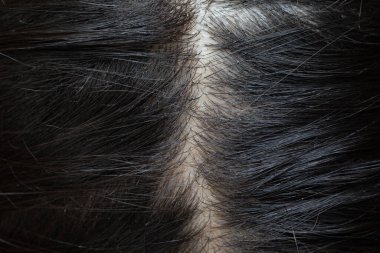 Bir kadının kafa derisine yakın çekim, seyrelen saç ve saç kaybını ortaya çıkarmak, birçok insanı etkileyen yaygın bir sorun