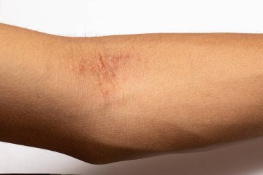 Close-up of irritated skin exhibiting an allergic reaction with redness and inflammation on a person's arm