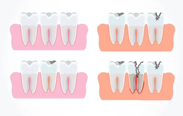 蛀牙的阶段与龋齿。牙科和口腔护理 — 图库矢量图片
