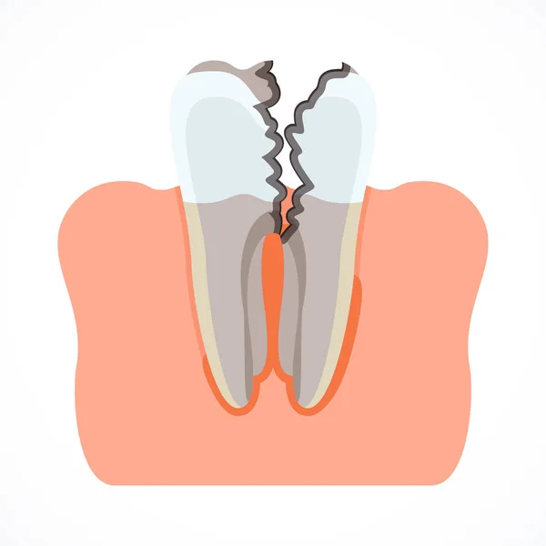 蛀牙的阶段与龋齿。牙科和口腔护理 — 图库矢量图片