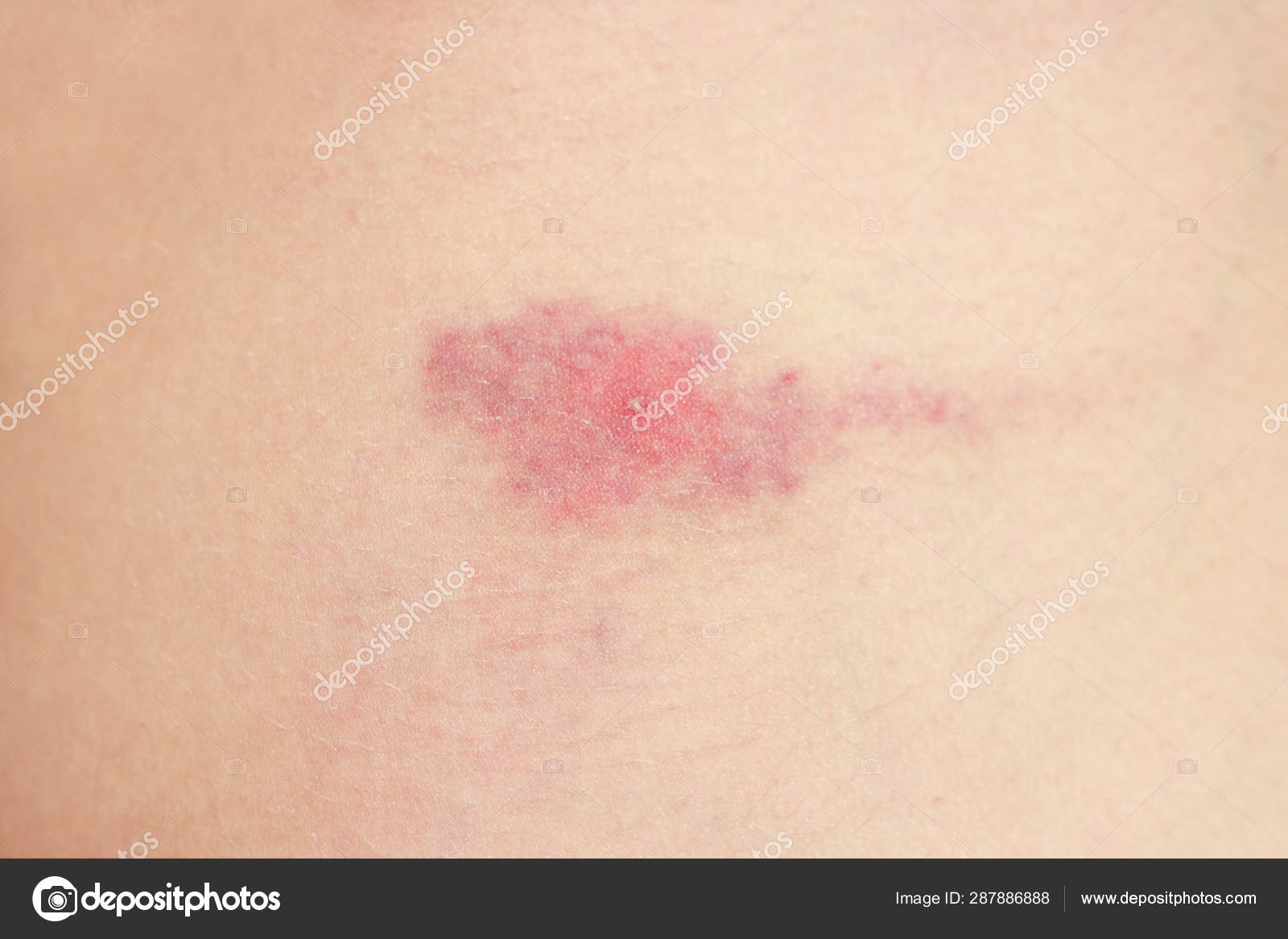 蚊虫叮咬。 对蚂蚁叮咬的反应。 过敏。 夏天昆虫叮咬的危险。 一天后咬地的红斑——图库图片© Wolfness72 #287886888, image size:1600x1167