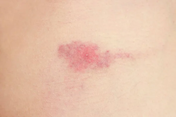 Myggbett. reaktion på bett av myggor. Allergi. risk för insektsbett på sommaren. röd fläck på bitstället efter en dag — Stockfoto