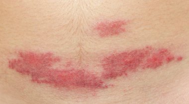 Sivrisinek ısırığı. Midge ısırığına karşı bir tepki. Alerji. Yazın böcek ısırığı tehlikesi. Bir gün sonra ısırılan kırmızı nokta.