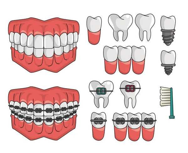 Sada prvků zubní rovnátka — Stockový vektor