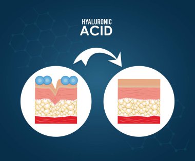 Hyaluronik asit dolgu enjeksiyonu Infographic
