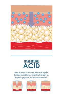Hyaluronik asit dolgu enjeksiyonu Infographic